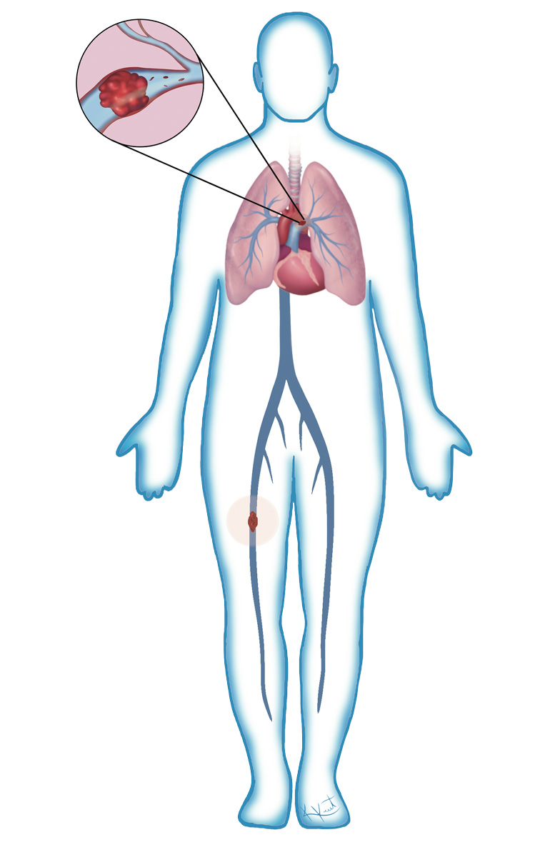 Figure showing pulmonary embolism blood clot formation